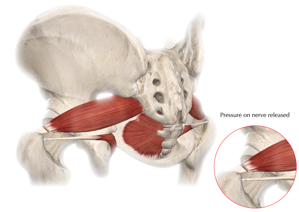 Piriformis Syndrome FAQs Hip and Pelvis Doctor Articles Asia